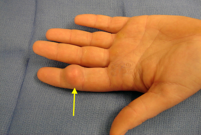 Sebaceous Cyst Hand Surgery Source